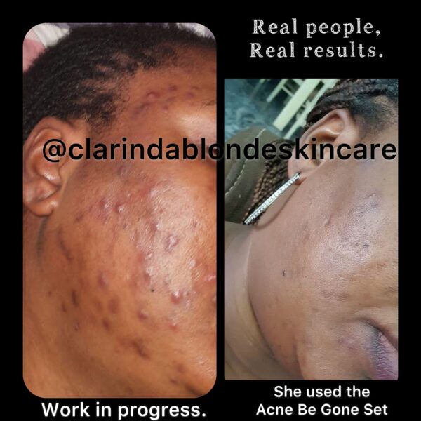 ACNE BE GONE SET Skin Care Clarinda Blonde