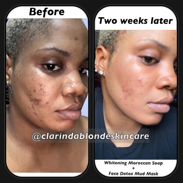 ACNE BE GONE SET Skin Care Clarinda Blonde