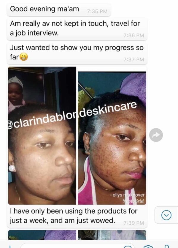 ACNE BE GONE SET Skin Care Clarinda Blonde