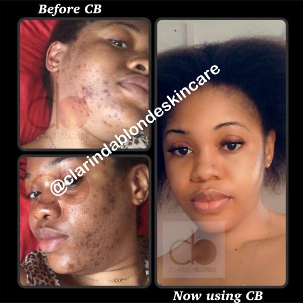 ACNE BE GONE SET Skin Care Clarinda Blonde