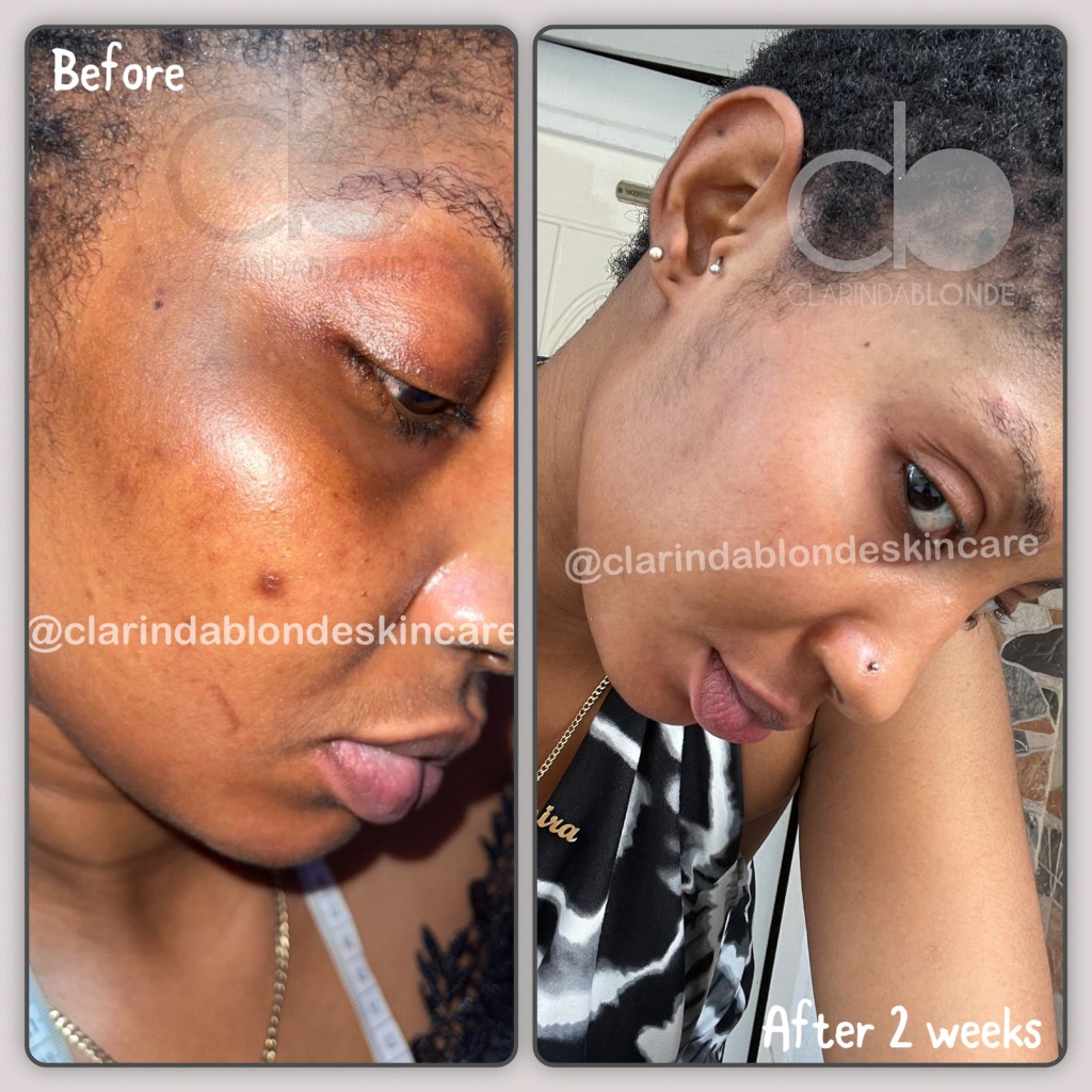 Facial dark spots before and after 2 weeks of using Clarinda Blonde products