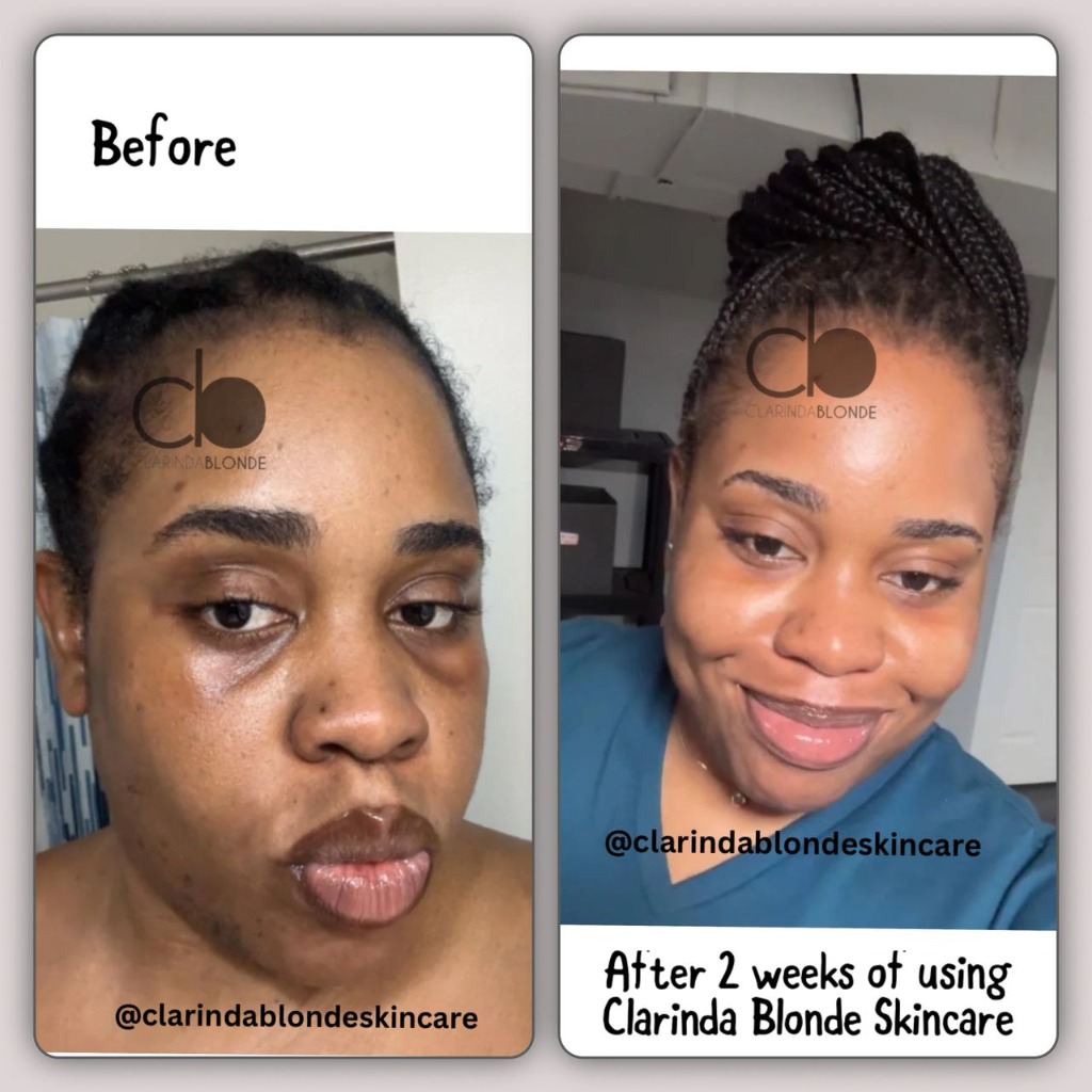 Clarinda Blonde Skincare face brightening result after 2 weeks of use