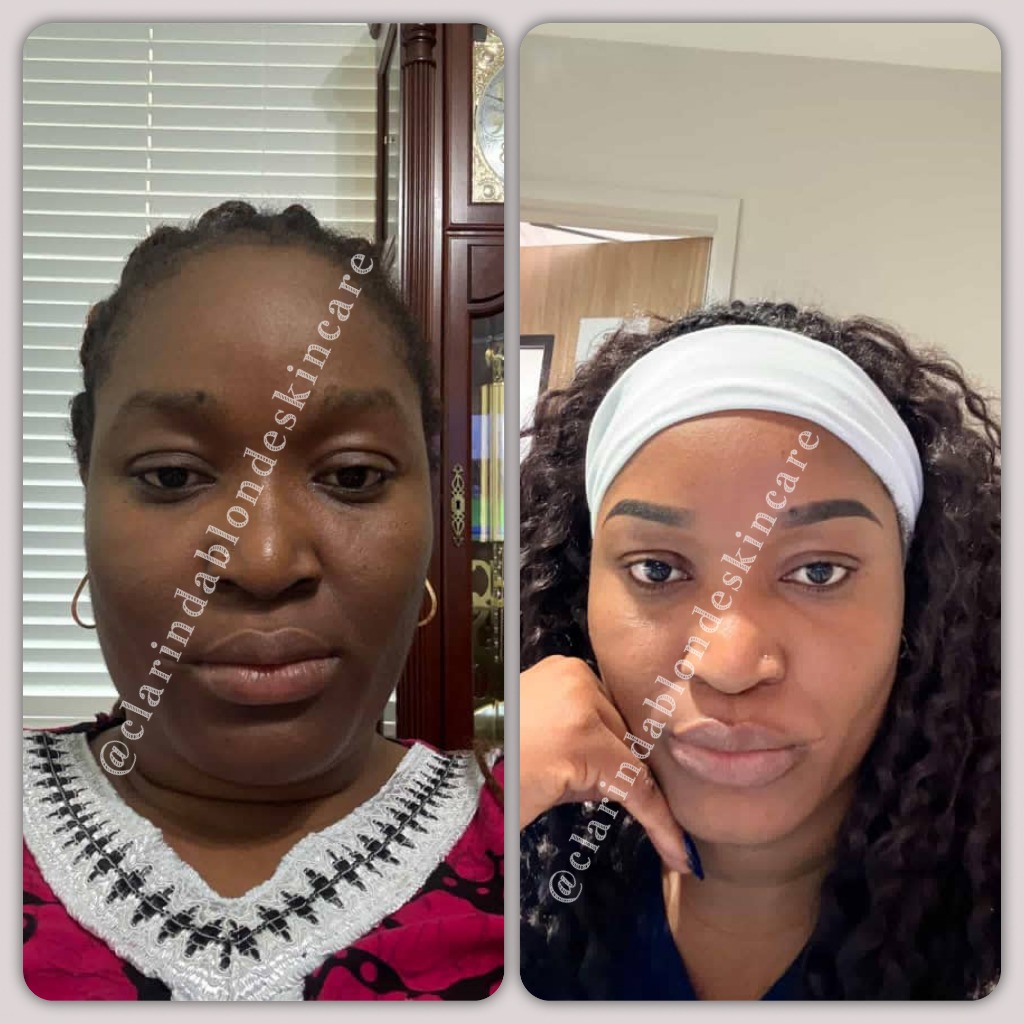 Clarinda Blonde Skincare hyperpigmentation clearing before and after transformation