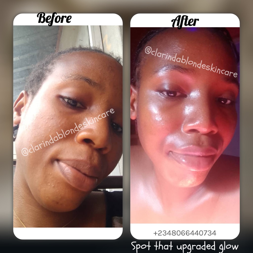 Clarinda Blonde Skincare upgraded glow spot treatment before and after
