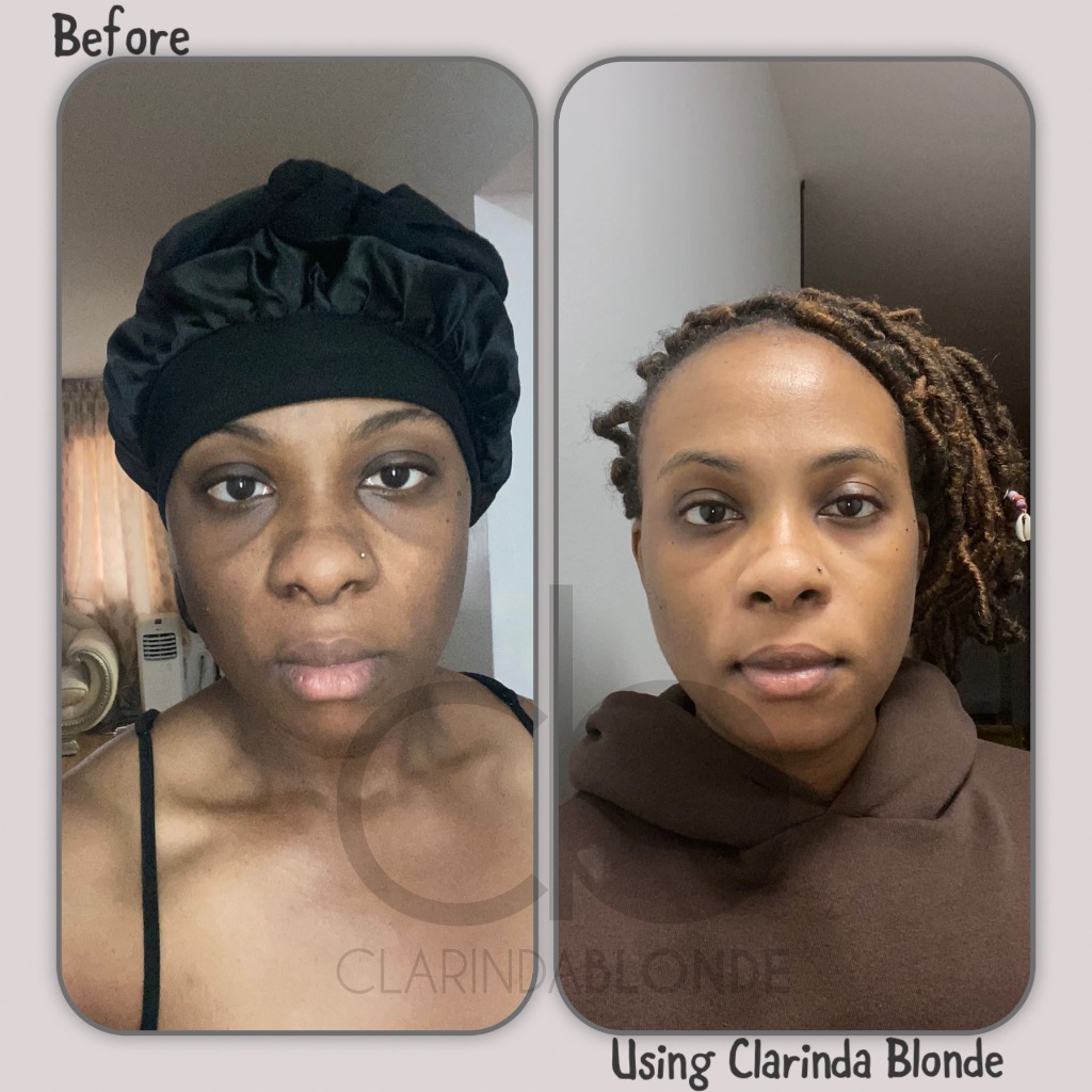 Under eye dark circles before and after using Clarinda Blonde skincare